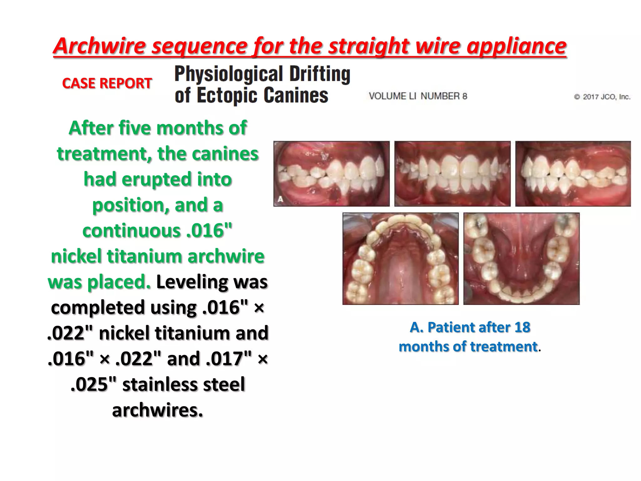 Archwire sequence for the straight wire appliance
After five months of
treatment, the canines
had erupted into
position, and a
continuous .016"
nickel titanium archwire
was placed. Leveling was
completed using .016" ×
.022" nickel titanium and
.016" × .022" and .017" ×
.025" stainless steel
archwires.
A. Patient after 18
months of treatment.
CASE REPORT
 