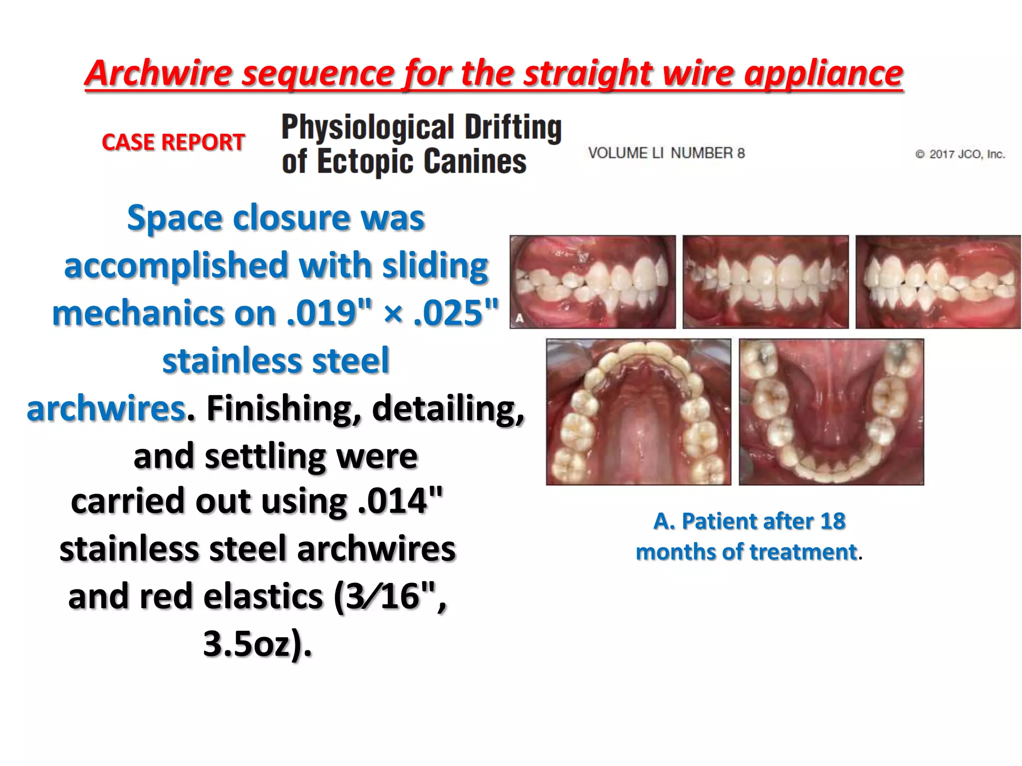 Archwire sequence for the straight wire appliance
A. Patient after 18
months of treatment.
Space closure was
accomplished with sliding
mechanics on .019" × .025"
stainless steel
archwires. Finishing, detailing,
and settling were
carried out using .014"
stainless steel archwires
and red elastics (3⁄16",
3.5oz).
CASE REPORT
 