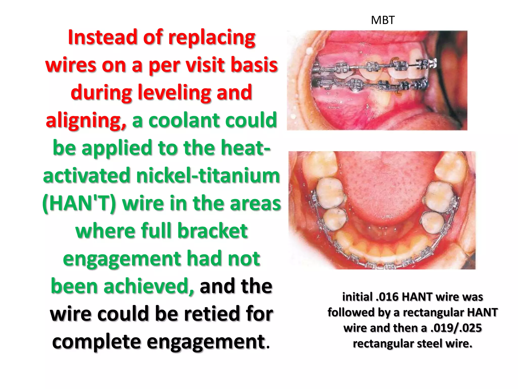 Instead of replacing
wires on a per visit basis
during leveling and
aligning, a coolant could
be applied to the heat-
activated nickel-titanium
(HAN'T) wire in the areas
where full bracket
engagement had not
been achieved, and the
wire could be retied for
complete engagement.
initial .016 HANT wire was
followed by a rectangular HANT
wire and then a .019/.025
rectangular steel wire.
MBT
 