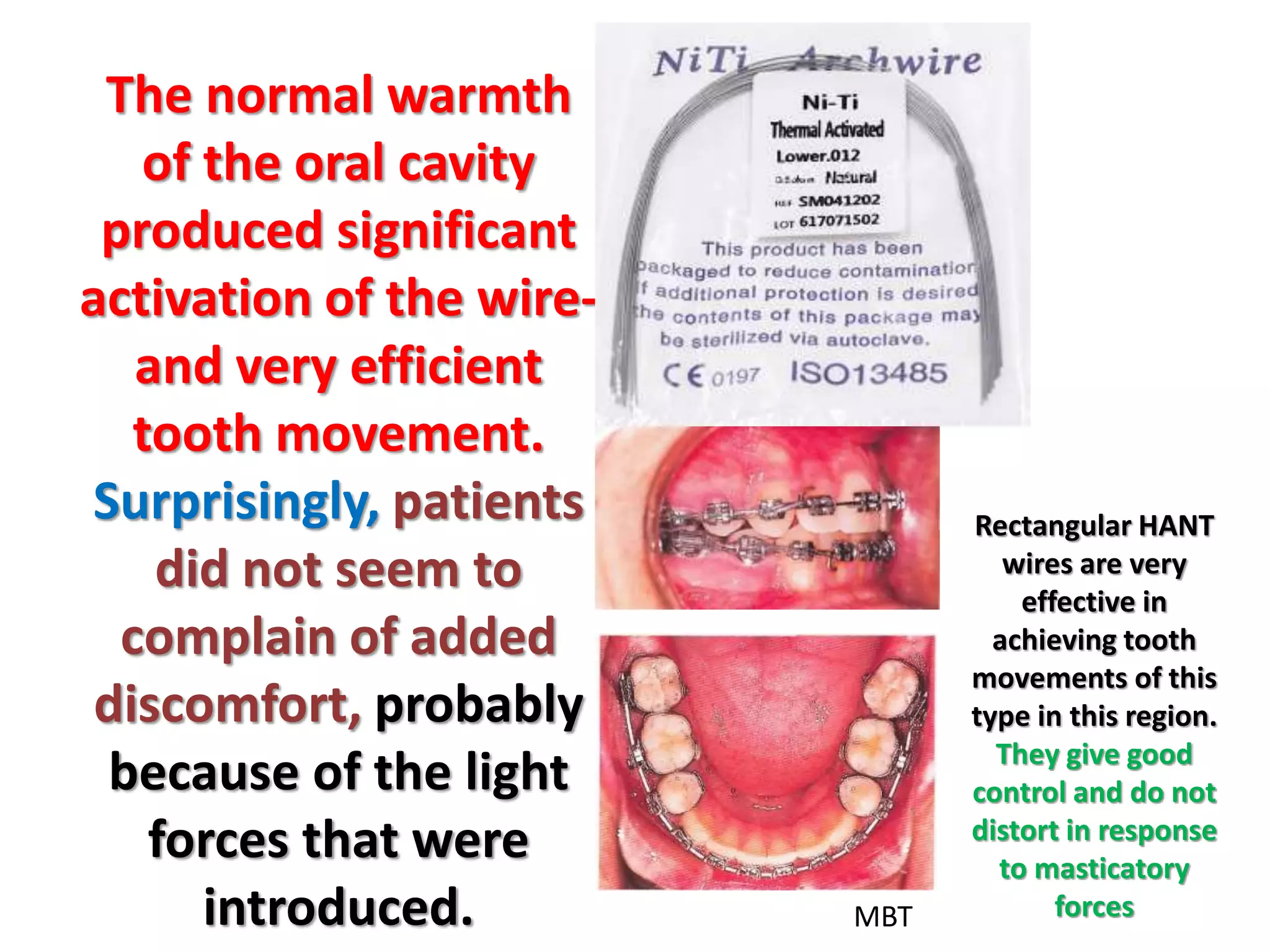 The normal warmth
of the oral cavity
produced significant
activation of the wire-
and very efficient
tooth movement.
Surprisingly, patients
did not seem to
complain of added
discomfort, probably
because of the light
forces that were
introduced.
Rectangular HANT
wires are very
effective in
achieving tooth
movements of this
type in this region.
They give good
control and do not
distort in response
to masticatory
forces
MBT
 