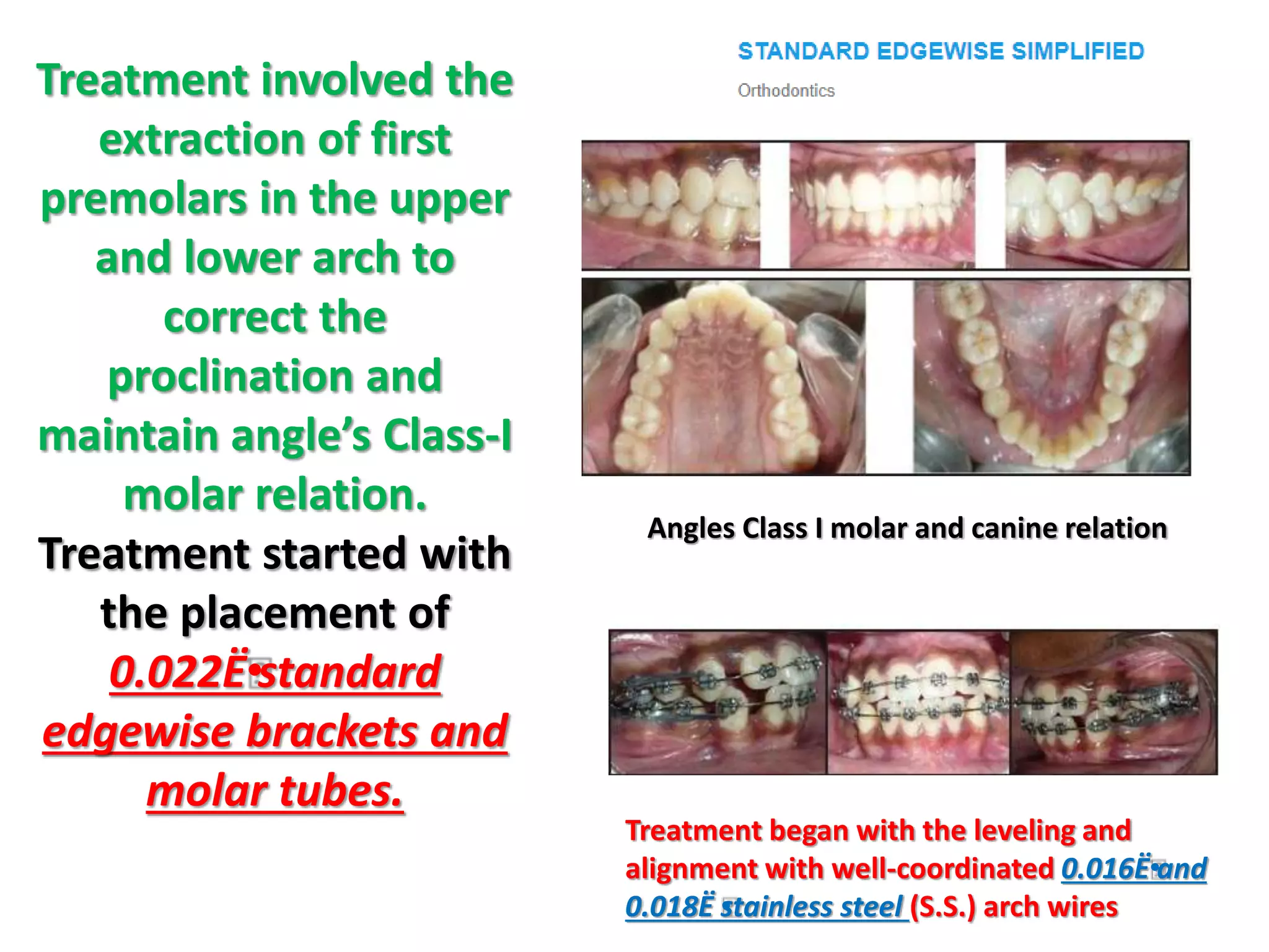 Treatment involved the
extraction of first
premolars in the upper
and lower arch to
correct the
proclination and
maintain angle’s Class-I
molar relation.
Treatment started with
the placement of
0.022Ë•
standard
edgewise brackets and
molar tubes.
Angles Class I molar and canine relation
Treatment began with the leveling and
alignment with well-coordinated 0.016Ë•
and
0.018Ë •
stainless steel (S.S.) arch wires
 