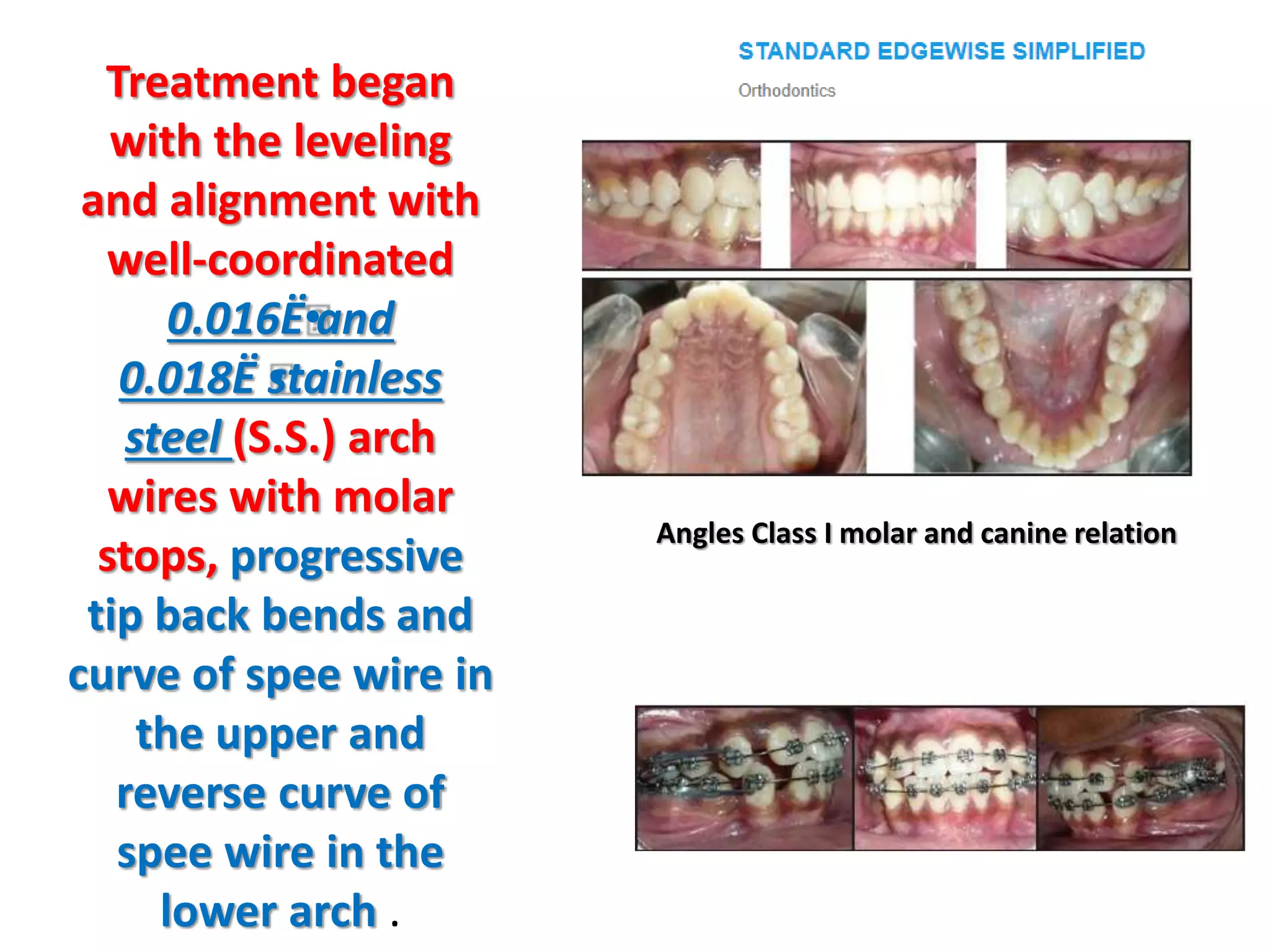 Treatment began
with the leveling
and alignment with
well-coordinated
0.016Ë•
and
0.018Ë •
stainless
steel (S.S.) arch
wires with molar
stops, progressive
tip back bends and
curve of spee wire in
the upper and
reverse curve of
spee wire in the
lower arch .
Angles Class I molar and canine relation
 