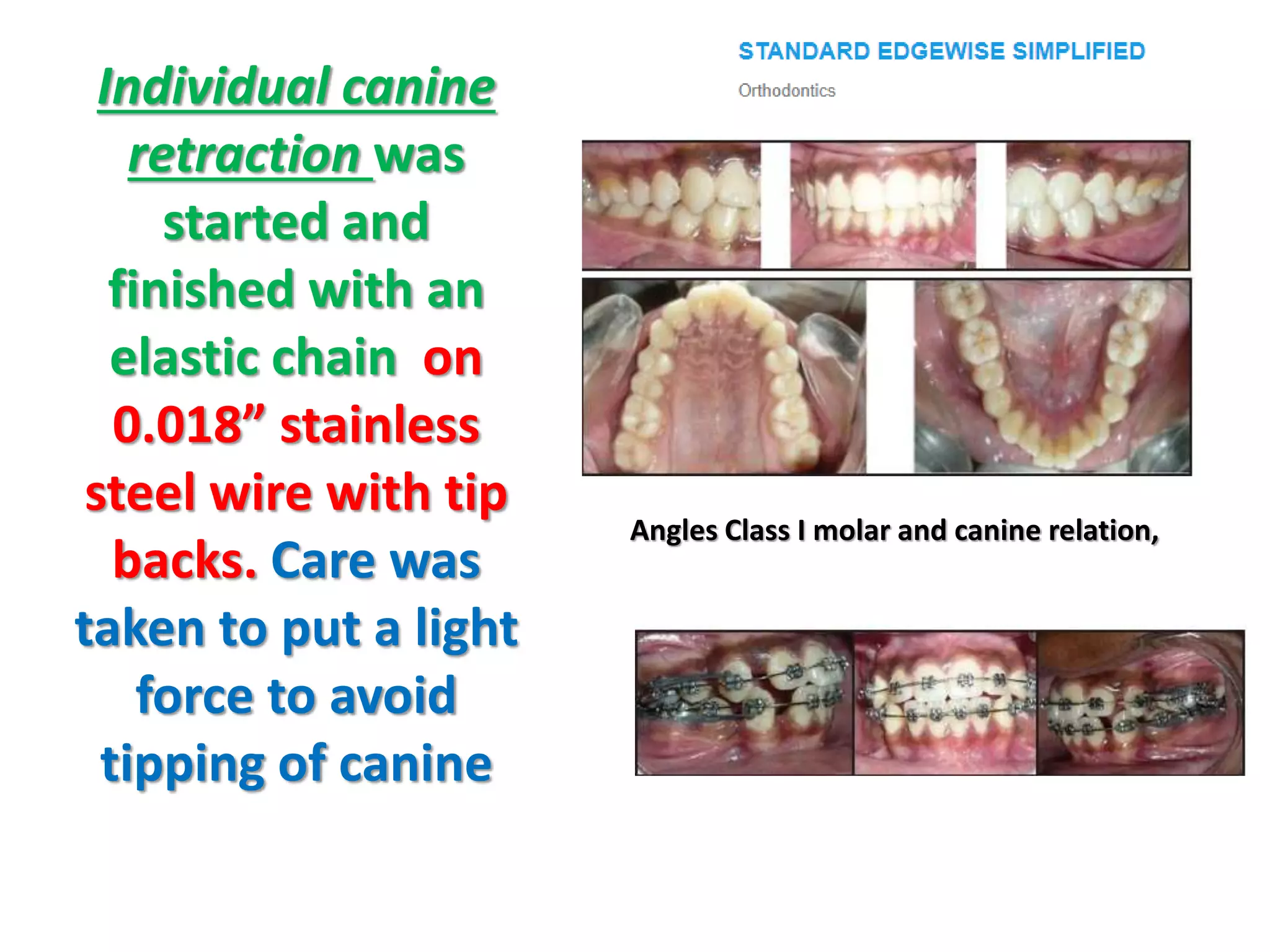 Individual canine
retraction was
started and
finished with an
elastic chain on
0.018” stainless
steel wire with tip
backs. Care was
taken to put a light
force to avoid
tipping of canine
Angles Class I molar and canine relation,
 