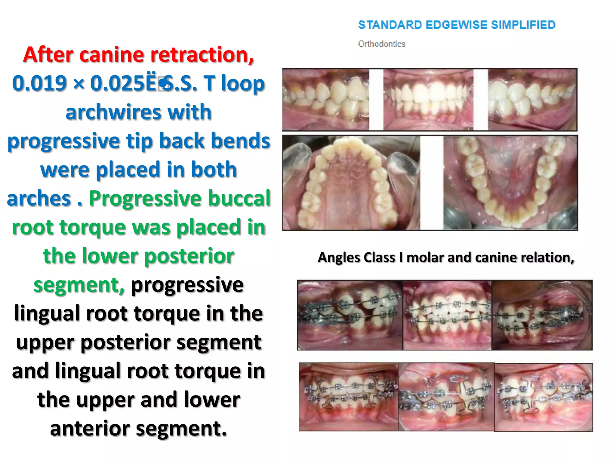 After canine retraction,
0.019 × 0.025Ë•
S.S. T loop
archwires with
progressive tip back bends
were placed in both
arches . Progressive buccal
root torque was placed in
the lower posterior
segment, progressive
lingual root torque in the
upper posterior segment
and lingual root torque in
the upper and lower
anterior segment.
Angles Class I molar and canine relation,
 