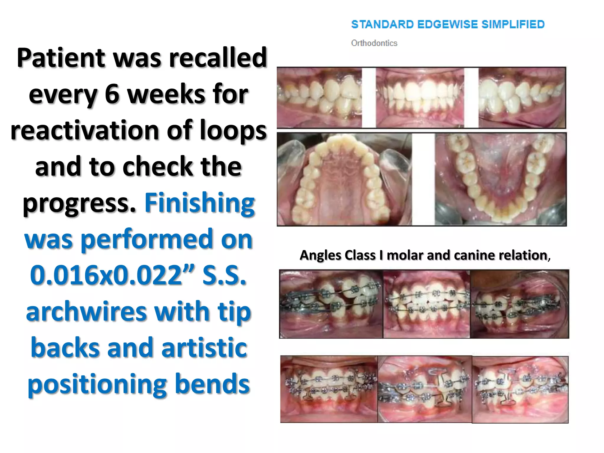 Patient was recalled
every 6 weeks for
reactivation of loops
and to check the
progress. Finishing
was performed on
0.016x0.022” S.S.
archwires with tip
backs and artistic
positioning bends
Angles Class I molar and canine relation,
 