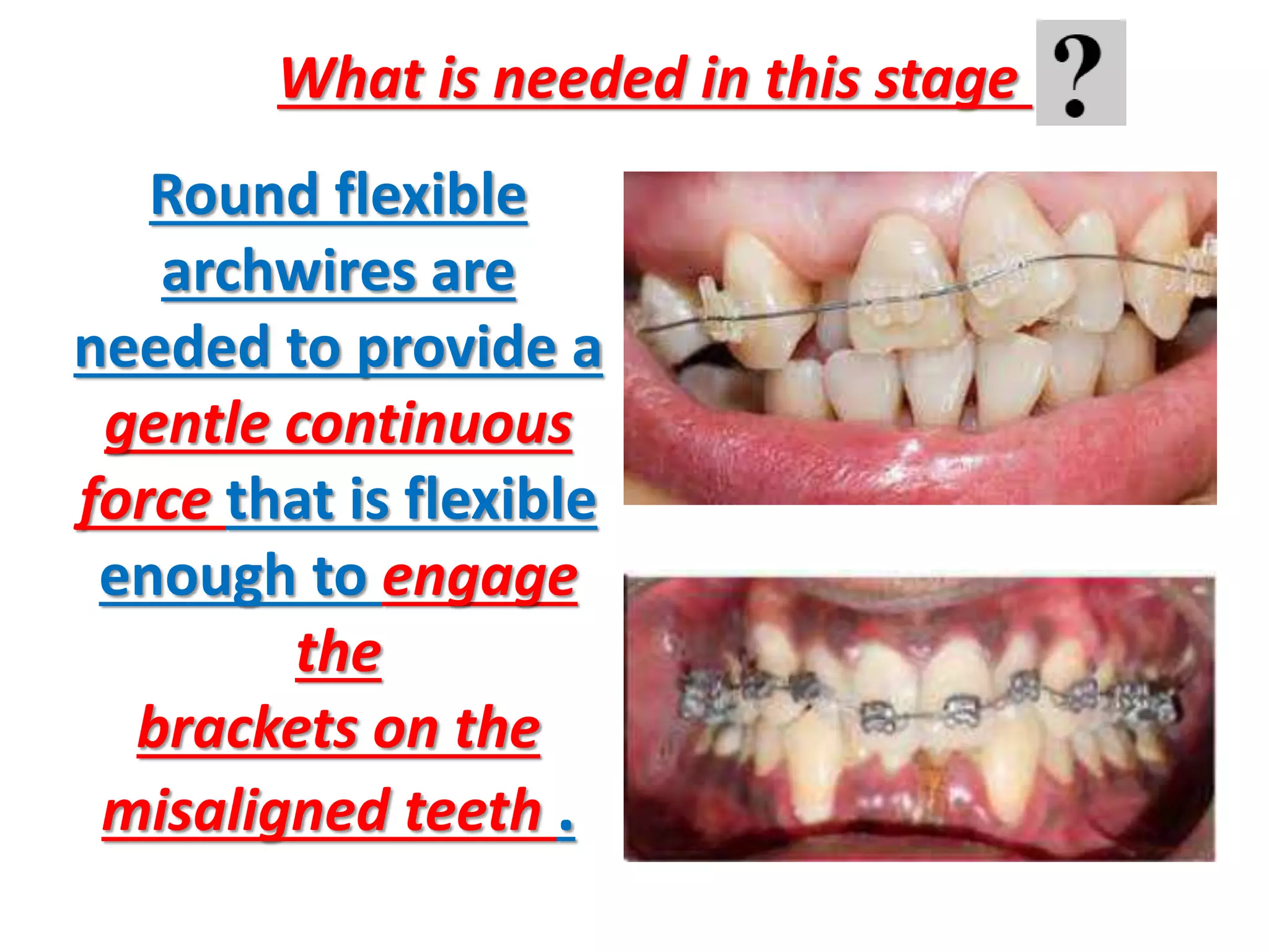 Round flexible
archwires are
needed to provide a
gentle continuous
force that is flexible
enough to engage
the
brackets on the
misaligned teeth .
What is needed in this stage
 