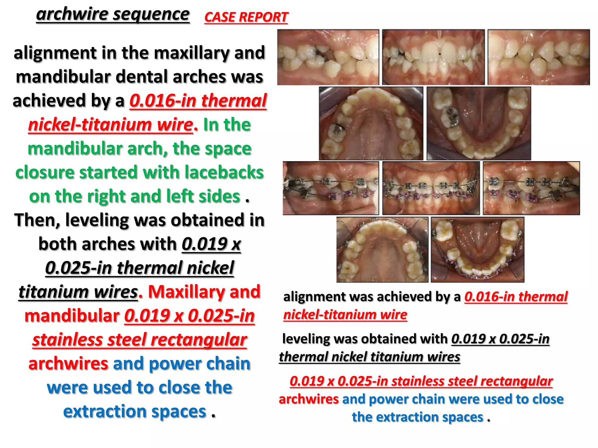 alignment in the maxillary and
mandibular dental arches was
achieved by a 0.016-in thermal
nickel-titanium wire. In the
mandibular arch, the space
closure started with lacebacks
on the right and left sides .
Then, leveling was obtained in
both arches with 0.019 x
0.025-in thermal nickel
titanium wires. Maxillary and
mandibular 0.019 x 0.025-in
stainless steel rectangular
archwires and power chain
were used to close the
extraction spaces .
archwire sequence CASE REPORT
alignment was achieved by a 0.016-in thermal
nickel-titanium wire
leveling was obtained with 0.019 x 0.025-in
thermal nickel titanium wires
0.019 x 0.025-in stainless steel rectangular
archwires and power chain were used to close
the extraction spaces .
 