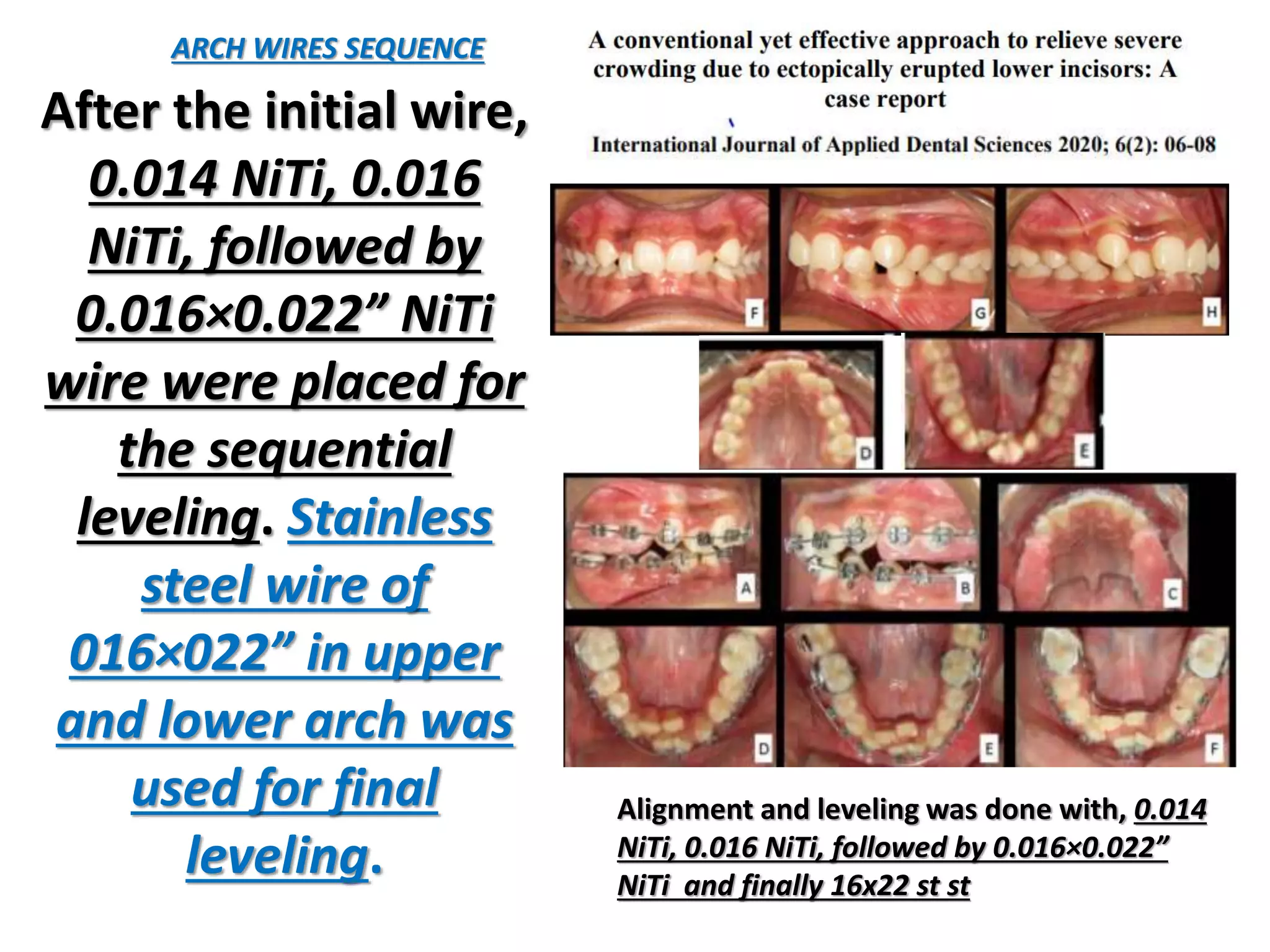 After the initial wire,
0.014 NiTi, 0.016
NiTi, followed by
0.016×0.022” NiTi
wire were placed for
the sequential
leveling. Stainless
steel wire of
016×022” in upper
and lower arch was
used for final
leveling.
ARCH WIRES SEQUENCE
Alignment and leveling was done with, 0.014
NiTi, 0.016 NiTi, followed by 0.016×0.022”
NiTi and finally 16x22 st st
 
