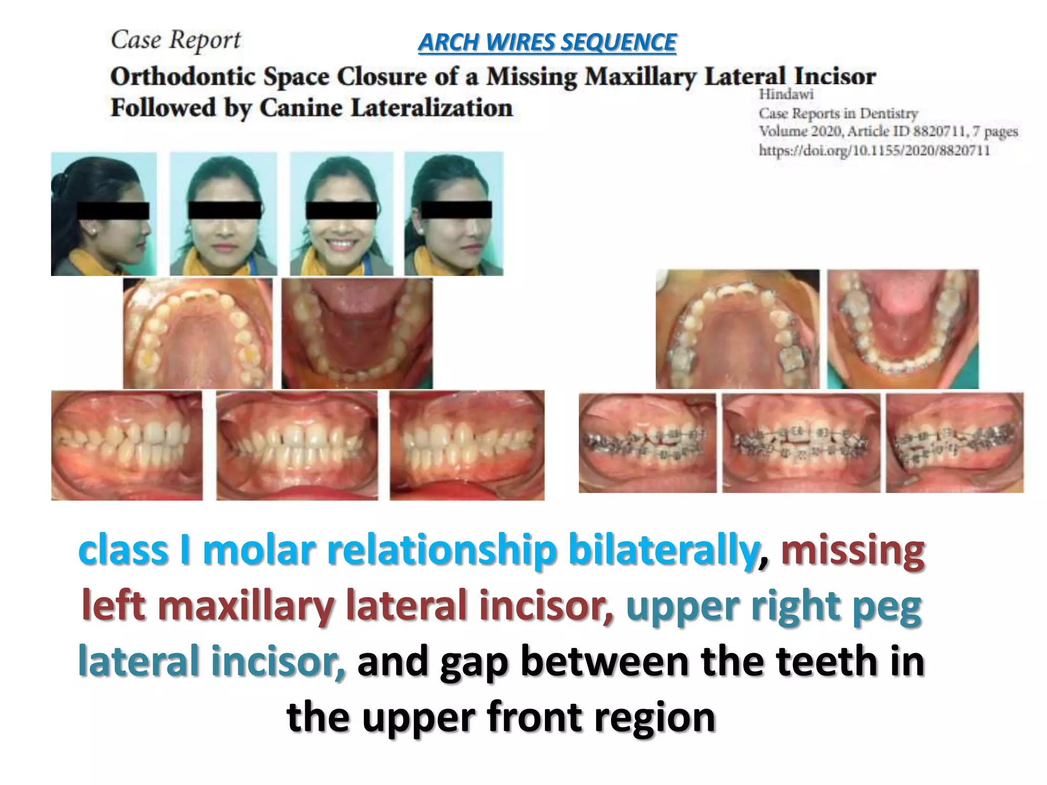 class I molar relationship bilaterally, missing
left maxillary lateral incisor, upper right peg
lateral incisor, and gap between the teeth in
the upper front region
ARCH WIRES SEQUENCE
 