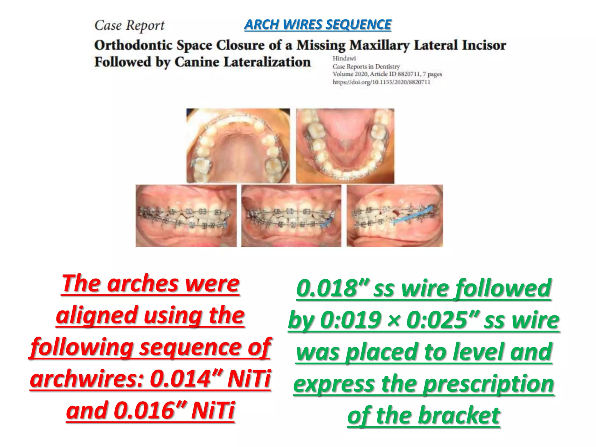 0.018″ ss wire followed
by 0:019 × 0:025″ ss wire
was placed to level and
express the prescription
of the bracket
ARCH WIRES SEQUENCE
The arches were
aligned using the
following sequence of
archwires: 0.014″ NiTi
and 0.016″ NiTi
 
