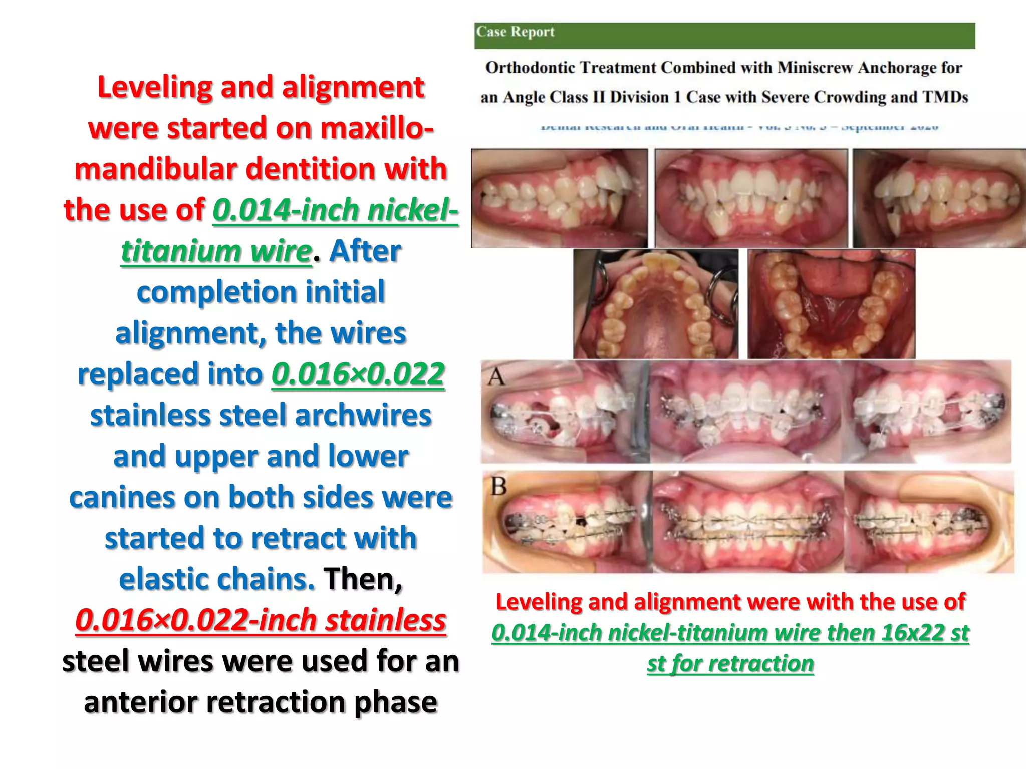 Leveling and alignment
were started on maxillo-
mandibular dentition with
the use of 0.014-inch nickel-
titanium wire. After
completion initial
alignment, the wires
replaced into 0.016×0.022
stainless steel archwires
and upper and lower
canines on both sides were
started to retract with
elastic chains. Then,
0.016×0.022-inch stainless
steel wires were used for an
anterior retraction phase
Leveling and alignment were with the use of
0.014-inch nickel-titanium wire then 16x22 st
st for retraction
 
