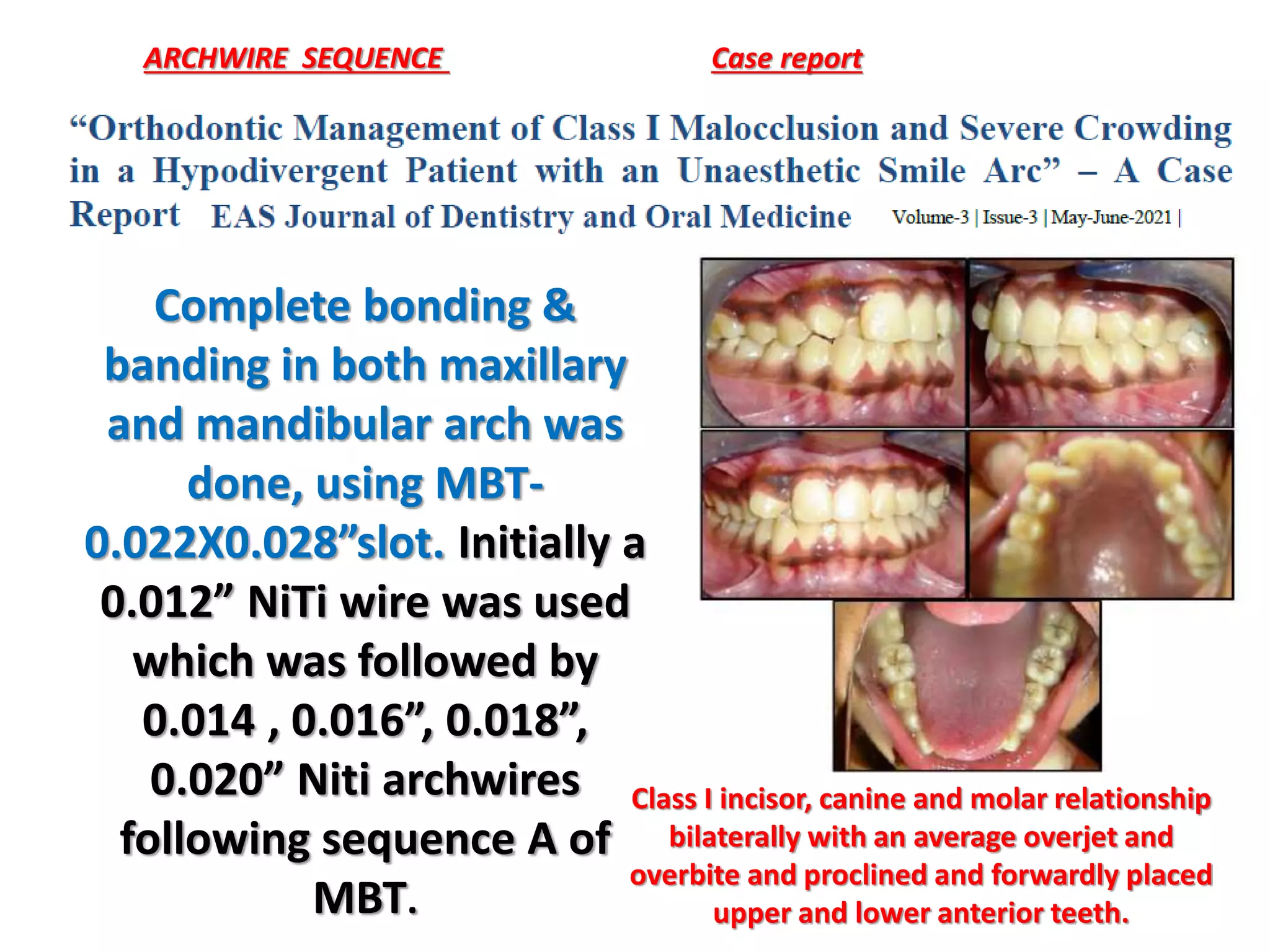 ARCHWIRE SEQUENCE Case report
Class I incisor, canine and molar relationship
bilaterally with an average overjet and
overbite and proclined and forwardly placed
upper and lower anterior teeth.
Complete bonding &
banding in both maxillary
and mandibular arch was
done, using MBT-
0.022X0.028”slot. Initially a
0.012” NiTi wire was used
which was followed by
0.014 , 0.016”, 0.018”,
0.020” Niti archwires
following sequence A of
MBT.
 