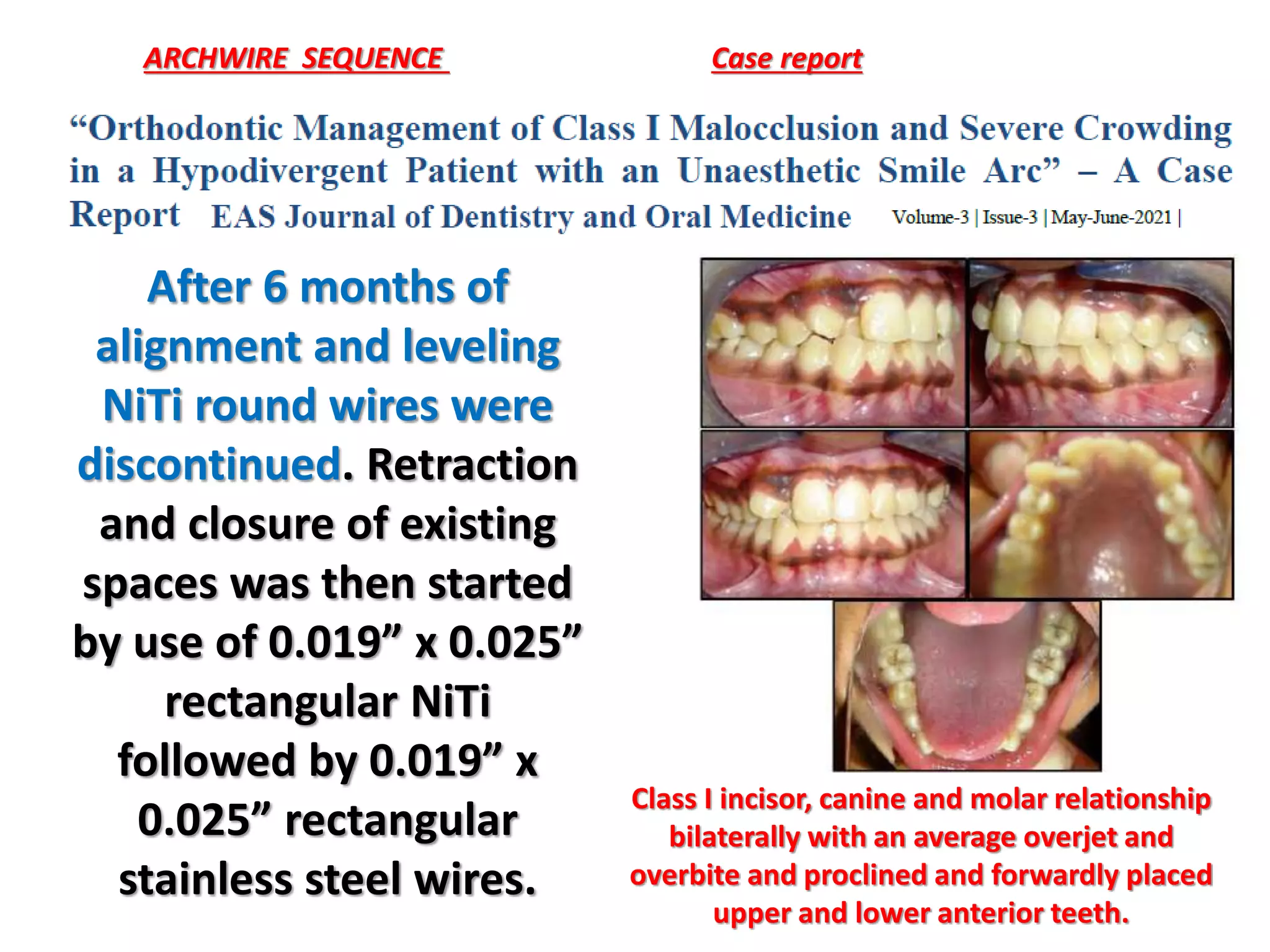 ARCHWIRE SEQUENCE Case report
Class I incisor, canine and molar relationship
bilaterally with an average overjet and
overbite and proclined and forwardly placed
upper and lower anterior teeth.
After 6 months of
alignment and leveling
NiTi round wires were
discontinued. Retraction
and closure of existing
spaces was then started
by use of 0.019” x 0.025”
rectangular NiTi
followed by 0.019” x
0.025” rectangular
stainless steel wires.
 