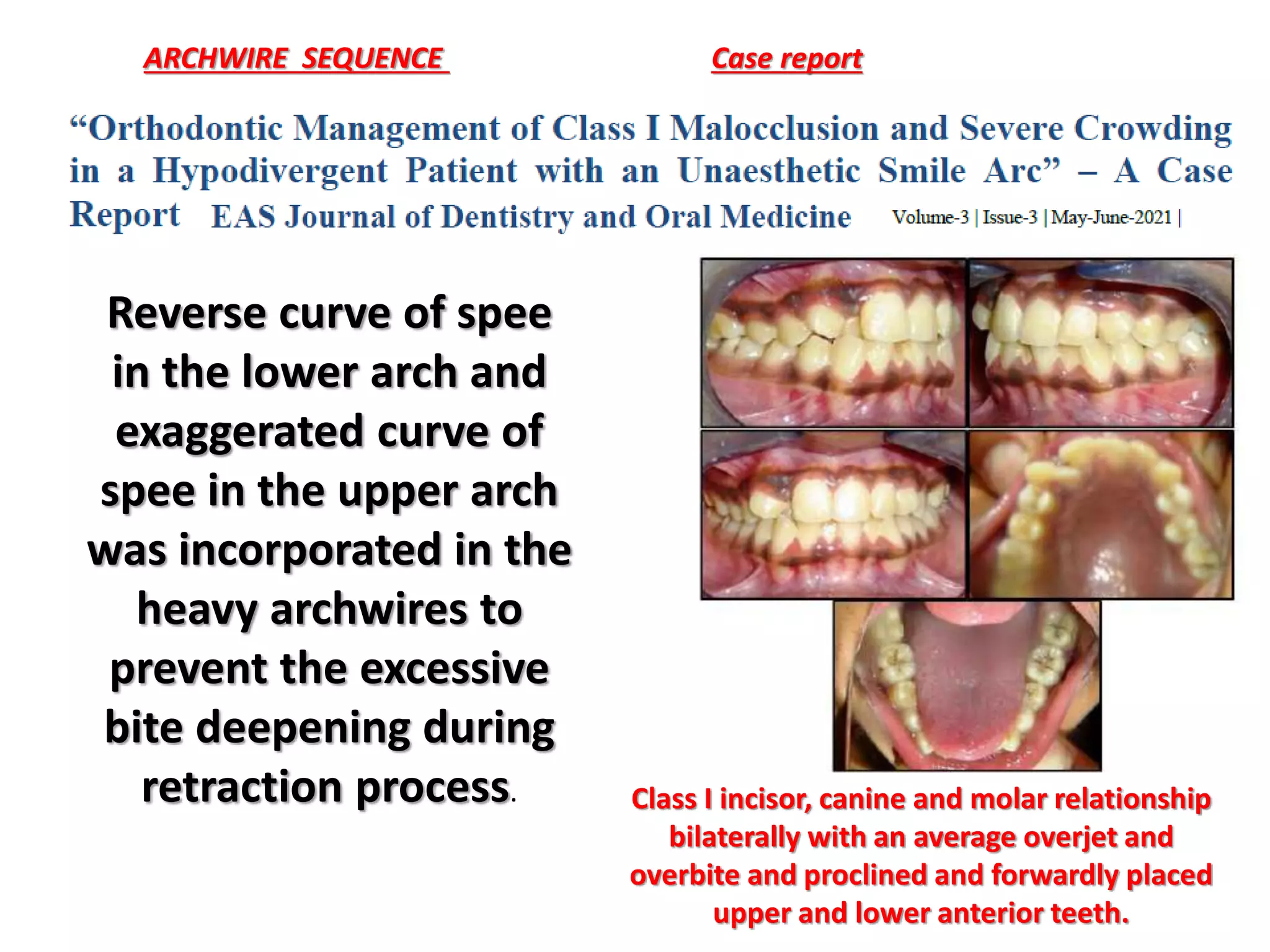 ARCHWIRE SEQUENCE Case report
Class I incisor, canine and molar relationship
bilaterally with an average overjet and
overbite and proclined and forwardly placed
upper and lower anterior teeth.
Reverse curve of spee
in the lower arch and
exaggerated curve of
spee in the upper arch
was incorporated in the
heavy archwires to
prevent the excessive
bite deepening during
retraction process.
 