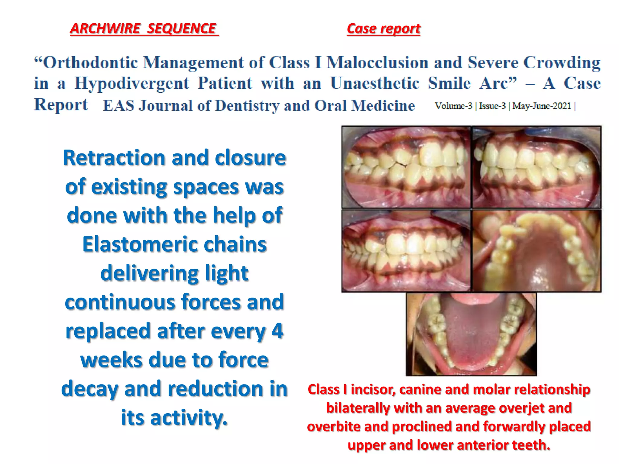 ARCHWIRE SEQUENCE Case report
Class I incisor, canine and molar relationship
bilaterally with an average overjet and
overbite and proclined and forwardly placed
upper and lower anterior teeth.
Retraction and closure
of existing spaces was
done with the help of
Elastomeric chains
delivering light
continuous forces and
replaced after every 4
weeks due to force
decay and reduction in
its activity.
 