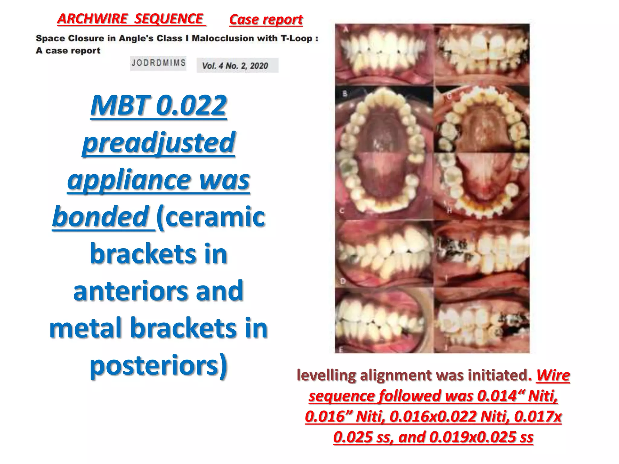 MBT 0.022
preadjusted
appliance was
bonded (ceramic
brackets in
anteriors and
metal brackets in
posteriors)
Case report
ARCHWIRE SEQUENCE
levelling alignment was initiated. Wire
sequence followed was 0.014“ Niti,
0.016” Niti, 0.016x0.022 Niti, 0.017x
0.025 ss, and 0.019x0.025 ss
 