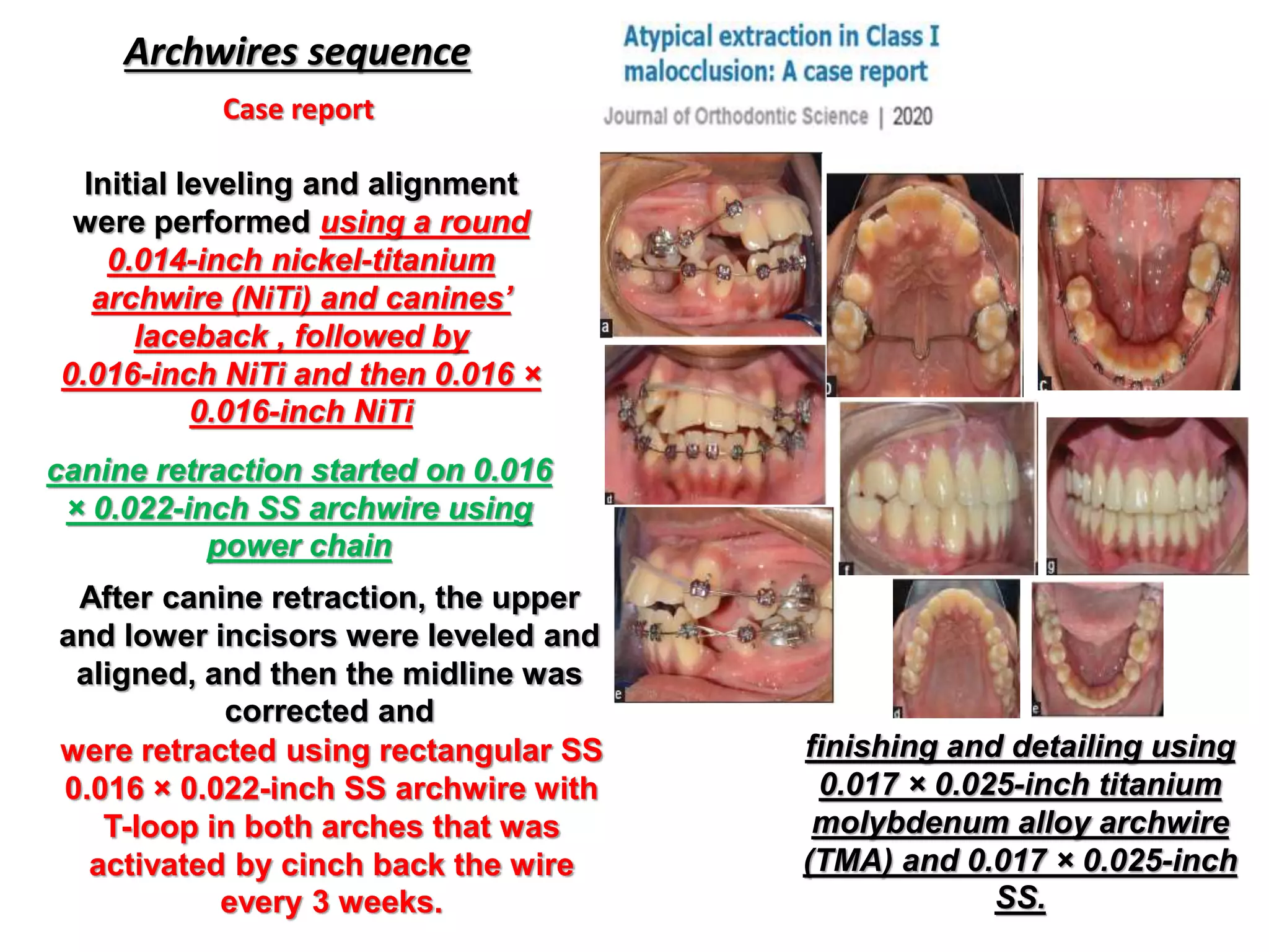 Archwires sequence
Initial leveling and alignment
were performed using a round
0.014-inch nickel-titanium
archwire (NiTi) and canines’
laceback , followed by
0.016-inch NiTi and then 0.016 ×
0.016-inch NiTi
Case report
canine retraction started on 0.016
× 0.022-inch SS archwire using
power chain
After canine retraction, the upper
and lower incisors were leveled and
aligned, and then the midline was
corrected and
were retracted using rectangular SS
0.016 × 0.022-inch SS archwire with
T-loop in both arches that was
activated by cinch back the wire
every 3 weeks.
finishing and detailing using
0.017 × 0.025-inch titanium
molybdenum alloy archwire
(TMA) and 0.017 × 0.025-inch
SS.
 