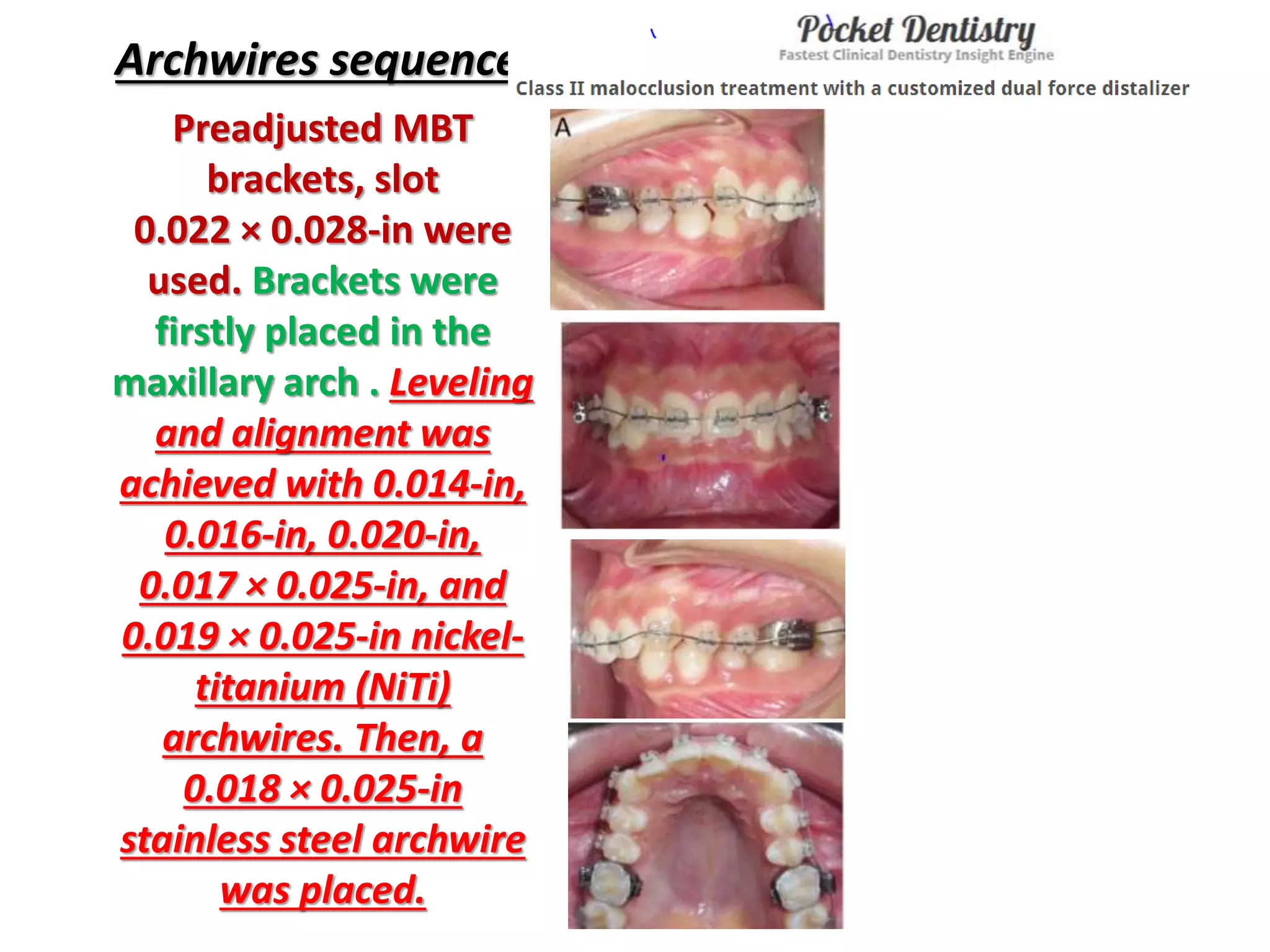 Archwires sequence
Preadjusted MBT
brackets, slot
0.022 × 0.028-in were
used. Brackets were
firstly placed in the
maxillary arch . Leveling
and alignment was
achieved with 0.014-in,
0.016-in, 0.020-in,
0.017 × 0.025-in, and
0.019 × 0.025-in nickel-
titanium (NiTi)
archwires. Then, a
0.018 × 0.025-in
stainless steel archwire
was placed.
 