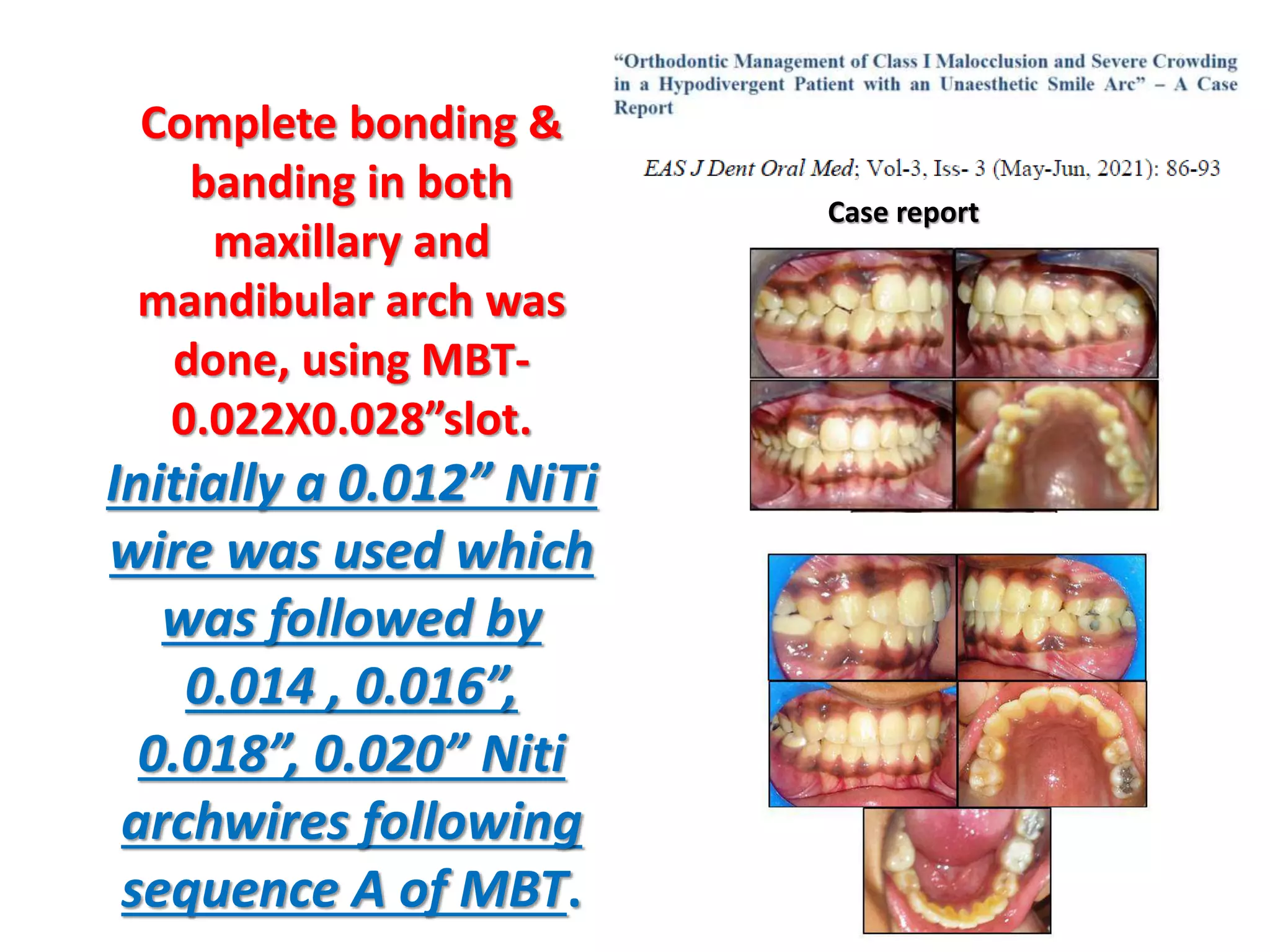 Complete bonding &
banding in both
maxillary and
mandibular arch was
done, using MBT-
0.022X0.028”slot.
Initially a 0.012” NiTi
wire was used which
was followed by
0.014 , 0.016”,
0.018”, 0.020” Niti
archwires following
sequence A of MBT.
Case report
 