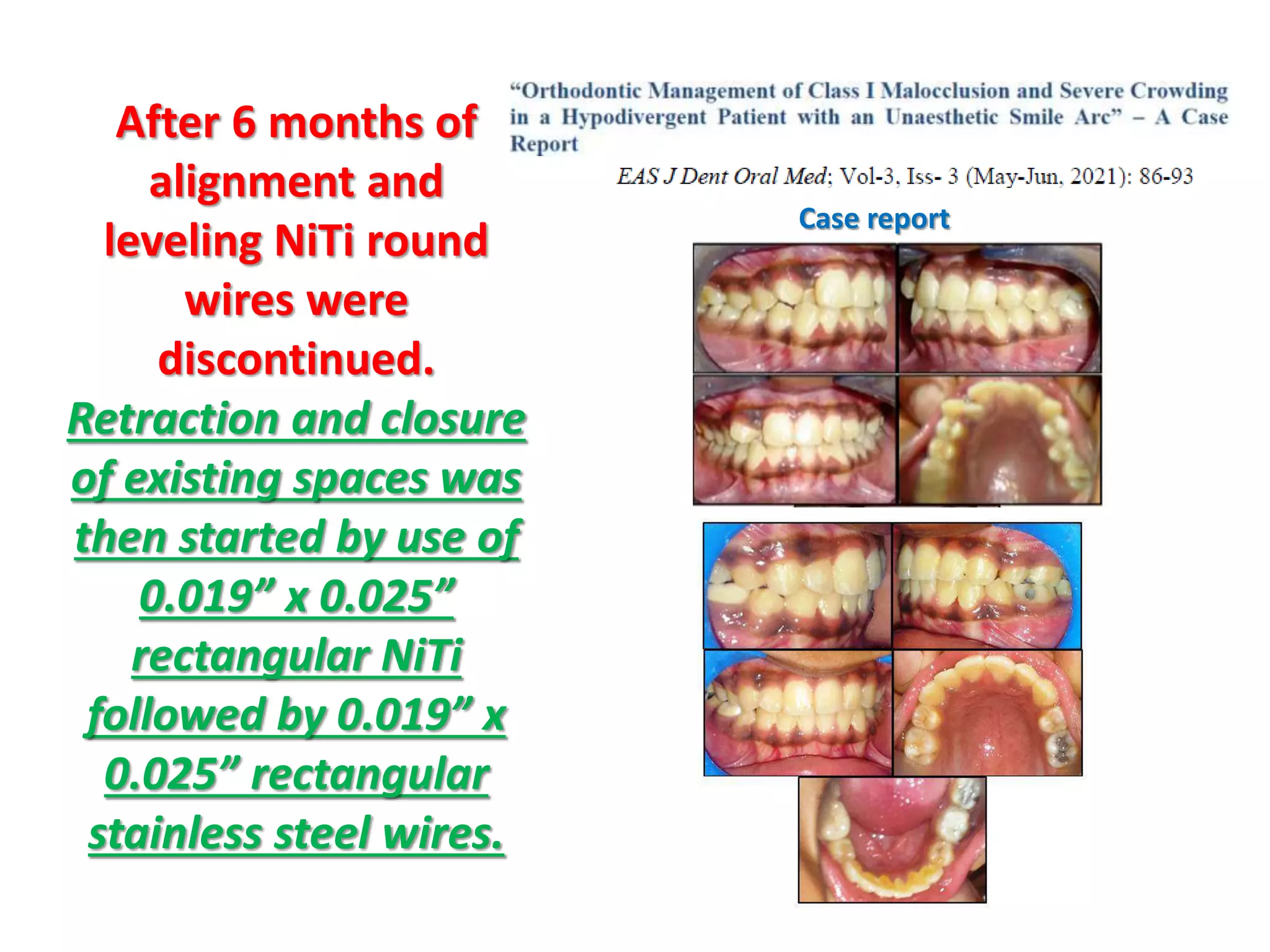 After 6 months of
alignment and
leveling NiTi round
wires were
discontinued.
Retraction and closure
of existing spaces was
then started by use of
0.019” x 0.025”
rectangular NiTi
followed by 0.019” x
0.025” rectangular
stainless steel wires.
Case report
 