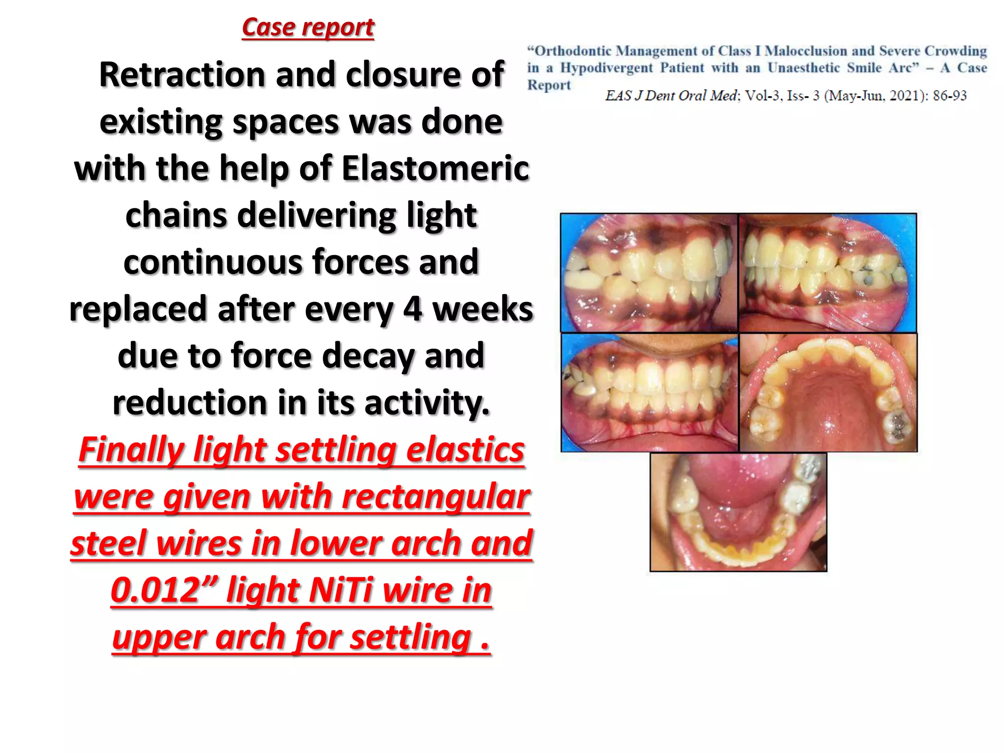 Retraction and closure of
existing spaces was done
with the help of Elastomeric
chains delivering light
continuous forces and
replaced after every 4 weeks
due to force decay and
reduction in its activity.
Finally light settling elastics
were given with rectangular
steel wires in lower arch and
0.012” light NiTi wire in
upper arch for settling .
Case report
 