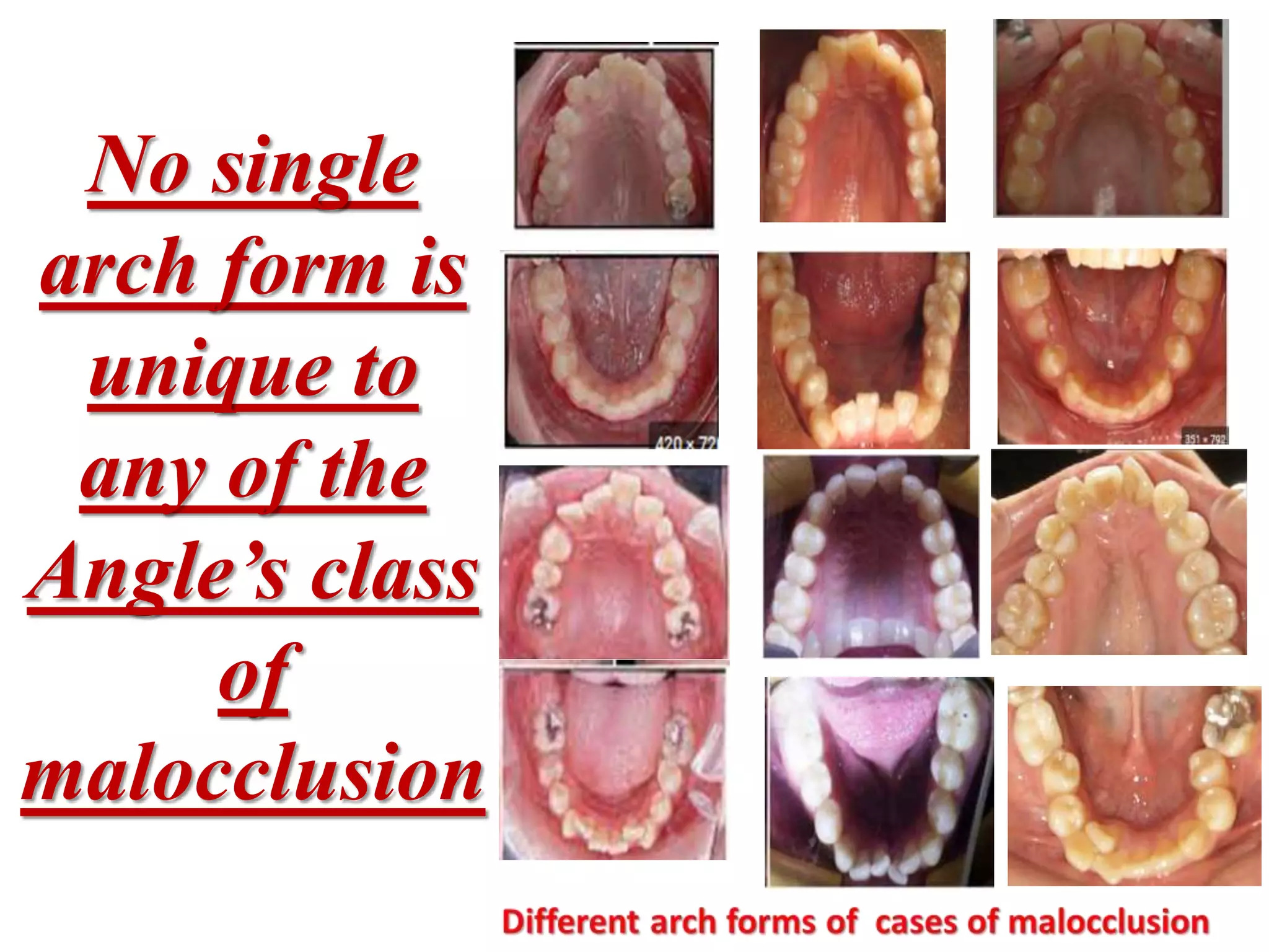 No single
arch form is
unique to
any of the
Angle’s class
of
malocclusion
 