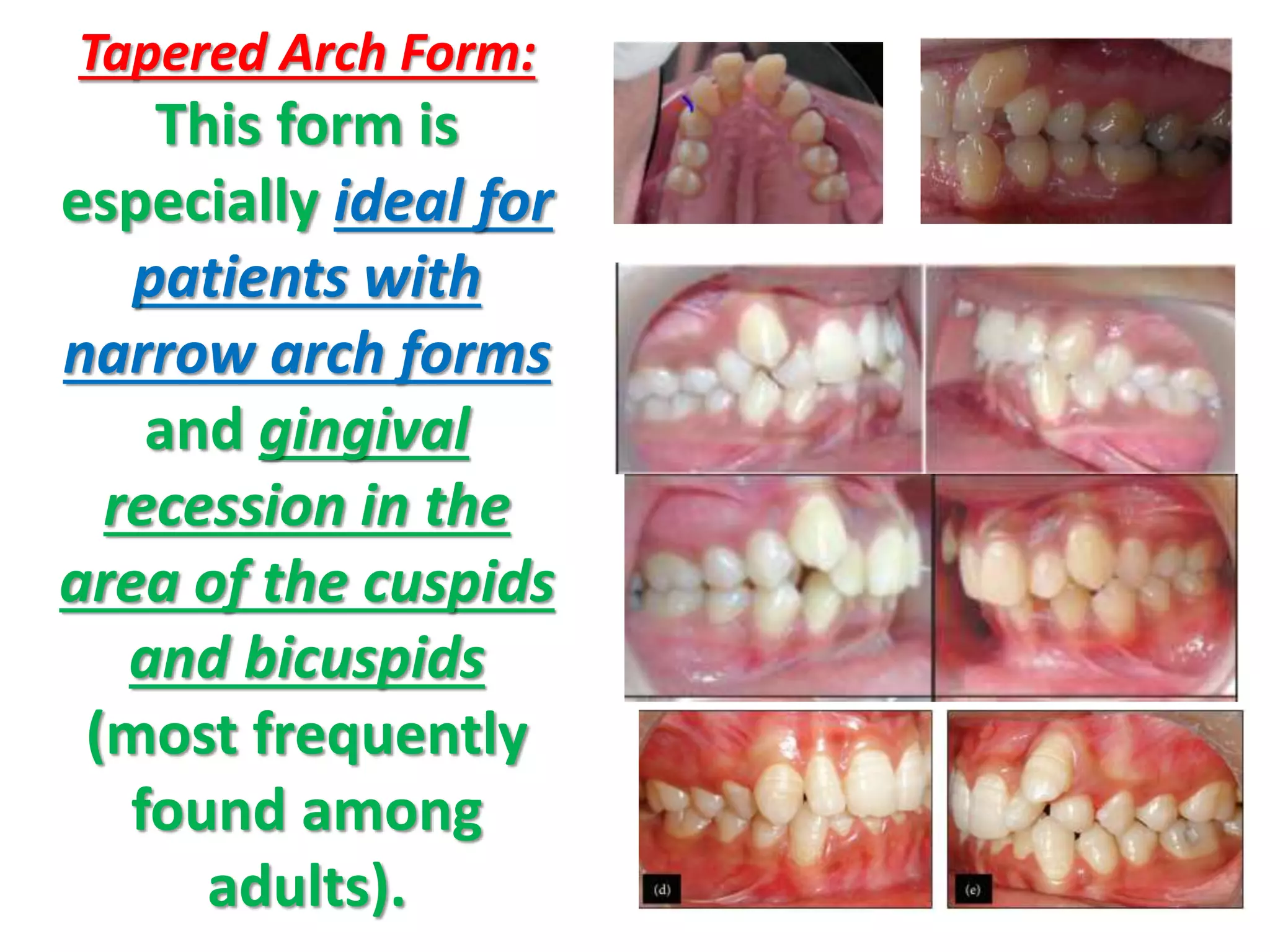 Tapered Arch Form:
This form is
especially ideal for
patients with
narrow arch forms
and gingival
recession in the
area of the cuspids
and bicuspids
(most frequently
found among
adults).
 