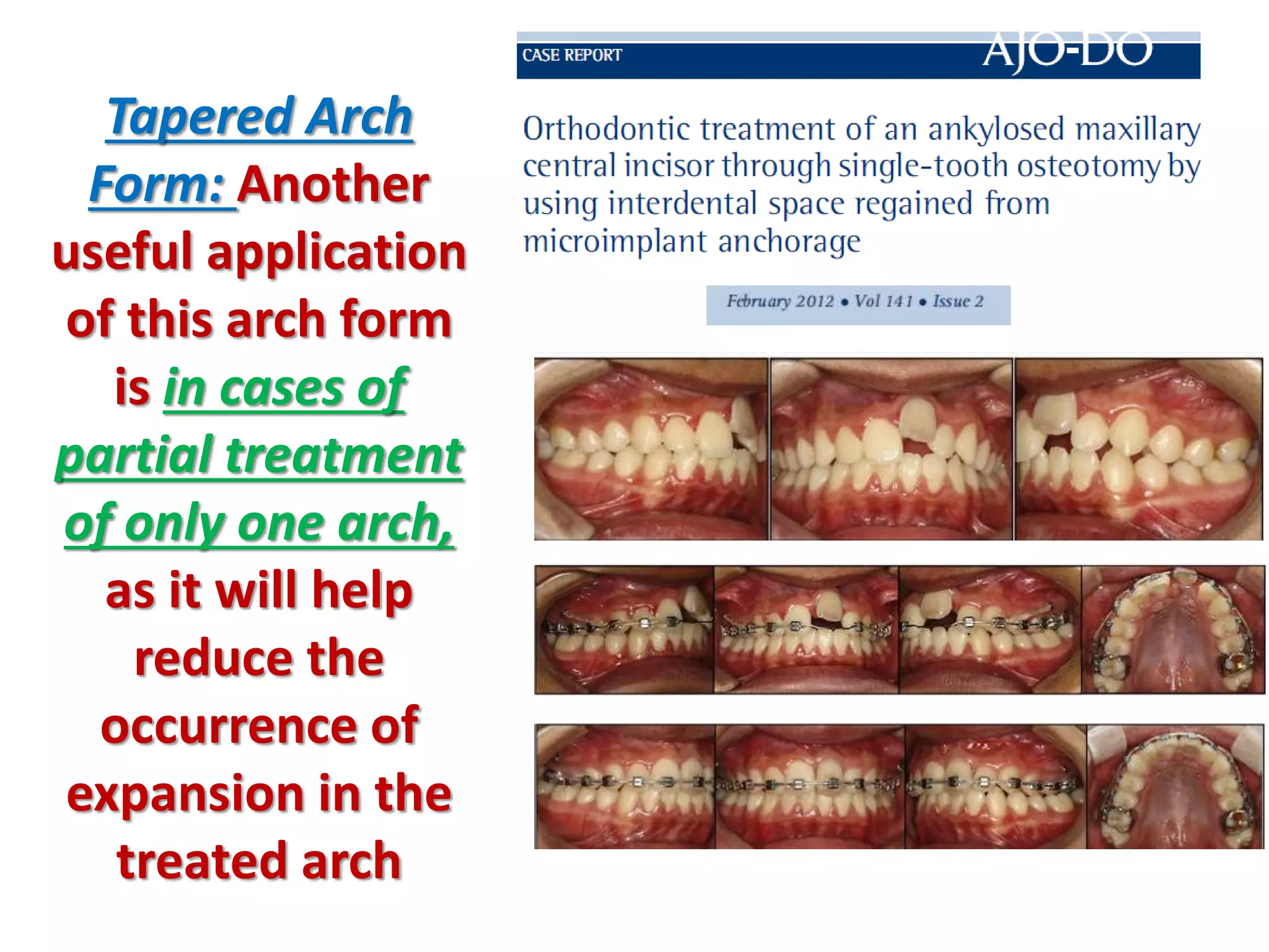 Tapered Arch
Form: Another
useful application
of this arch form
is in cases of
partial treatment
of only one arch,
as it will help
reduce the
occurrence of
expansion in the
treated arch
 