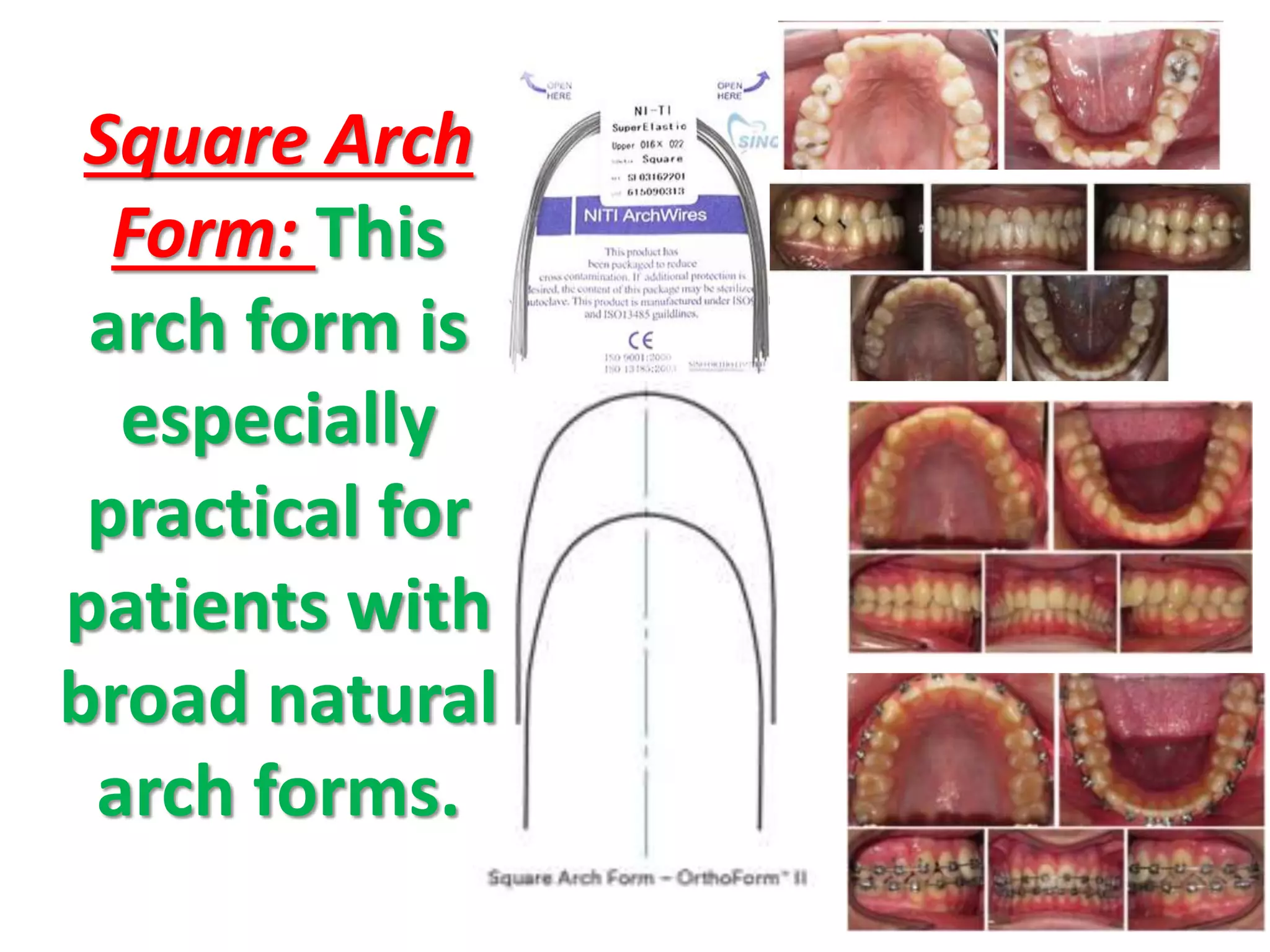 Square Arch
Form: This
arch form is
especially
practical for
patients with
broad natural
arch forms.
 