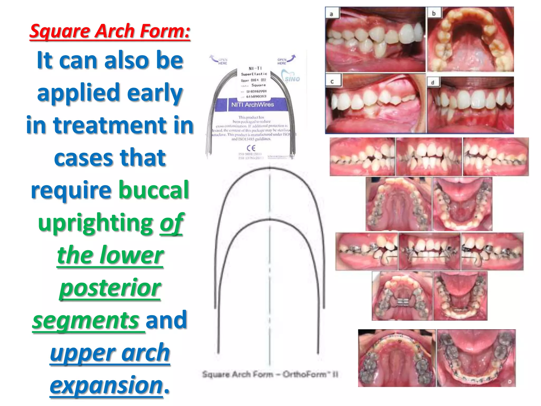Square Arch Form:
It can also be
applied early
in treatment in
cases that
require buccal
uprighting of
the lower
posterior
segments and
upper arch
expansion.
 