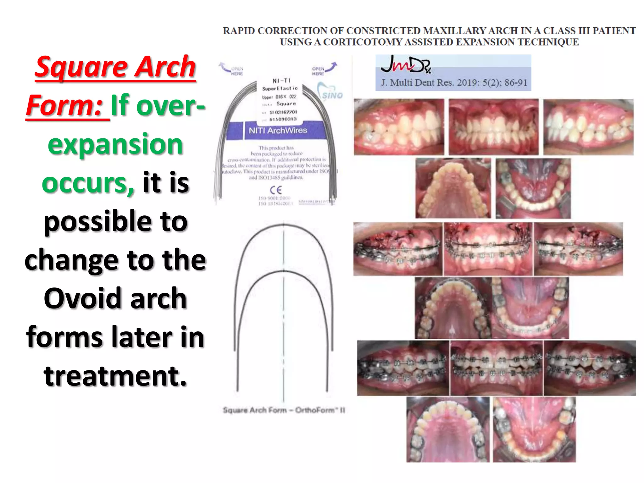 Square Arch
Form: If over-
expansion
occurs, it is
possible to
change to the
Ovoid arch
forms later in
treatment.
 