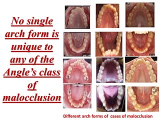 Selection Of Preformed Archwires During The Alignment Stage Of selection-of-preformed-archwires-during-the-alignment-stage-of