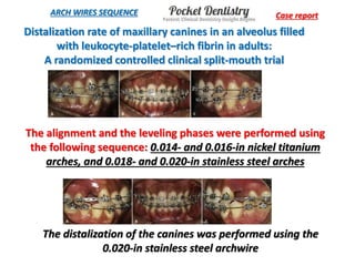Intermediate Alignment Stage selection of preformed archwires during the alignment stage of ...