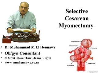 Selective
Cesarean
Myomectomy
• Dr Muhammad M El Hennawy
• Ob/gyn Consultant
• 59 Street - Rass el barr –dumyat - egypt
• www. mmhennawy.co.nr
 
