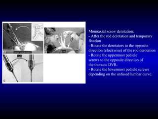 Selective fusion for idiopathic scoliosis review by dr.shashidhar b k | PPT