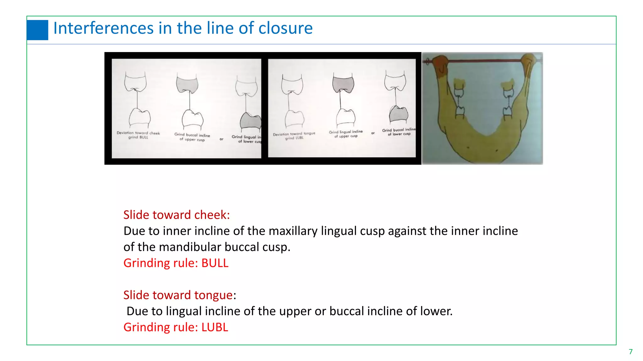 Slide toward cheek:
Due to inner incline of the maxillary lingual cusp against the inner incline
of the mandibular buccal cusp.
Grinding rule: BULL
Slide toward tongue:
Due to lingual incline of the upper or buccal incline of lower.
Grinding rule: LUBL
7
Interferences in the line of closure
 