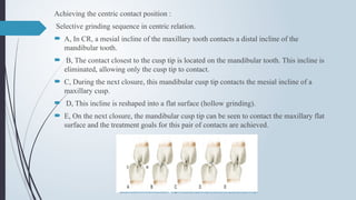 Achieving the centric contact position :
Selective grinding sequence in centric relation.
 A, In CR, a mesial incline of the maxillary tooth contacts a distal incline of the
mandibular tooth.
 B, The contact closest to the cusp tip is located on the mandibular tooth. This incline is
eliminated, allowing only the cusp tip to contact.
 C, During the next closure, this mandibular cusp tip contacts the mesial incline of a
maxillary cusp.
 D, This incline is reshaped into a flat surface (hollow grinding).
 E, On the next closure, the mandibular cusp tip can be seen to contact the maxillary flat
surface and the treatment goals for this pair of contacts are achieved.
 