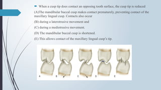  When a cusp tip does contact an opposing tooth surface, the cusp tip is reduced
(A)The mandibular buccal cusp makes contact prematurely, preventing contact of the
maxillary lingual cusp. Contacts also occur
(B) during a laterotrusive movement and
(C) during a mediotrusive movement.
(D) The mandibular buccal cusp is shortened.
(E) This allows contact of the maxillary lingual cusp’s tip.
 
