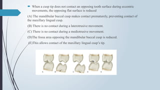  When a cusp tip does not contact an opposing tooth surface during eccentric
movements, the opposing flat surface is reduced
(A) The mandibular buccal cusp makes contact prematurely, preventing contact of
the maxillary lingual cusp.
(B) There is no contact during a laterotrusive movement.
(C) There is no contact during a mediotrusive movement.
(D)The fossa area opposing the mandibular buccal cusp is reduced.
(E)This allows contact of the maxillary lingual cusp’s tip.
 
