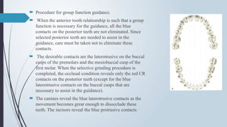 Procedure for group function guidance.
 When the anterior tooth relationship is such that a group
function is necessary for the guidance, all the blue
contacts on the posterior teeth are not eliminated. Since
selected posterior teeth are needed to assist in the
guidance, care must be taken not to eliminate these
contacts.
 The desirable contacts are the laterotrusive on the buccal
cusps of the premolars and the mesiobuccal cusp of the
first molar. When the selective grinding procedure is
completed, the occlusal condition reveals only the red CR
contacts on the posterior teeth (except for the blue
laterotrusive contacts on the buccal cusps that are
necessary to assist in the guidance).
 The canines reveal the blue laterotrusive contacts as the
movement becomes great enough to disocclude these
teeth. The incisors reveal the blue protrusive contacts
 