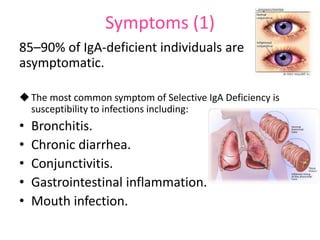 Symptoms (1)
85–90% of IgA-deficient individuals are
asymptomatic.
 The most common symptom of Selective IgA Deficiency is
susceptibility to infections including:

•
•
•
•
•

Bronchitis.
Chronic diarrhea.
Conjunctivitis.
Gastrointestinal inflammation.
Mouth infection.

 
