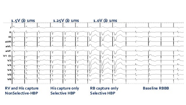 Selective Vs Nonselective His Bundle Capture