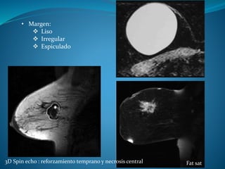 • Margen:
 Liso
 Irregular
 Espiculado
3D Spin echo : reforzamiento temprano y necrosis central Fat sat
 