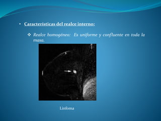• Características del realce interno:
 Realce homogéneo: Es uniforme y confluente en toda la
masa.
Linfoma
 