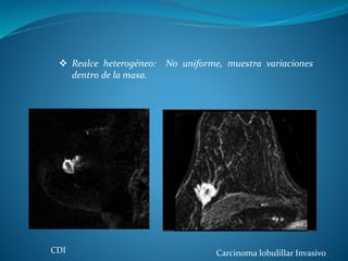  Realce heterogéneo: No uniforme, muestra variaciones
dentro de la masa.
Carcinoma lobulillar InvasivoCDI
 