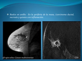  Realce en anillo: En la periferia de la masa, (carcinoma ductal,
necrosis y quistes con inflamación.
3D spin echo: Cáncer multicéntrico CDI CDI
 