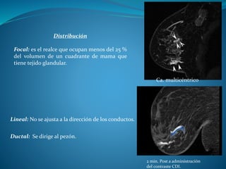 Lineal: No se ajusta a la dirección de los conductos.
Distribución
Focal: es el realce que ocupan menos del 25 %
del volumen de un cuadrante de mama que
tiene tejido glandular.
Ca. multicéntrico
2 min. Post a administración
del contraste CDI.
Ductal: Se dirige al pezón.
 