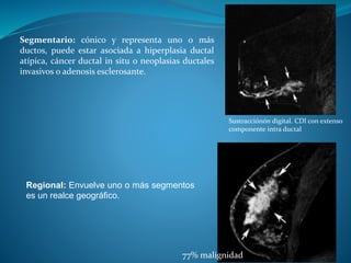 Sustracciónón digital. CDI con extenso
componente intra ductal
Segmentario: cónico y representa uno o más
ductos, puede estar asociada a hiperplasia ductal
atípica, cáncer ductal in situ o neoplasias ductales
invasivos o adenosis esclerosante.
Regional: Envuelve uno o más segmentos
es un realce geográfico.
77% malignidad
 