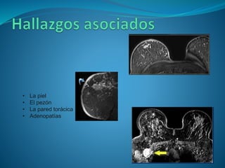 • La piel
• El pezón
• La pared torácica
• Adenopatías
 