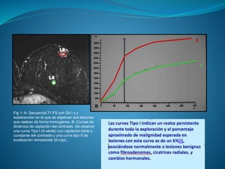 A
B
Fig 1- A- Secuencia T1 FS con Gd i.v y
substracción en la que se objetivan dos lesiones
que realzan de forma homogénea. B- Curvas de
dinámica de captación del contraste. Se observa
una curva Tipo I (4-verde) con captación lenta y
constante del contraste y una curva tipo II de
localización retroareolar (6-roja).
4
6
 